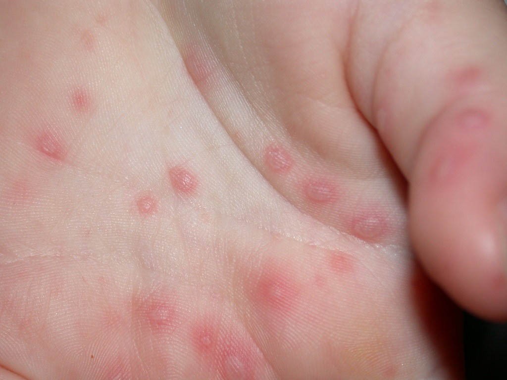 Dịch bệnh tay chân miệng ở trẻ em