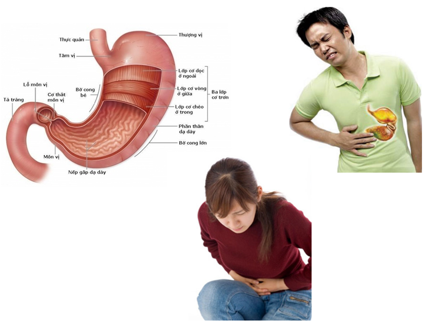 Bệnh viêm dạ dày Bệnh viêm dạ dày